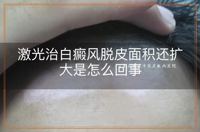 激光治白癜风脱皮面积还扩大是怎么回事