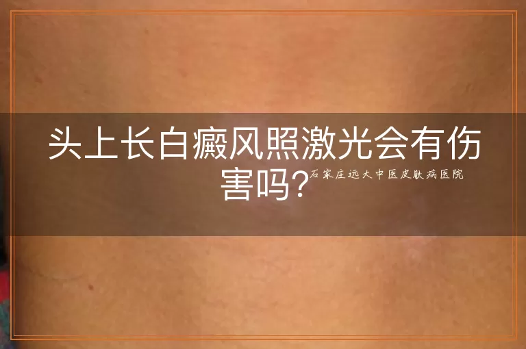 头上长白癜风照激光会有伤害吗？