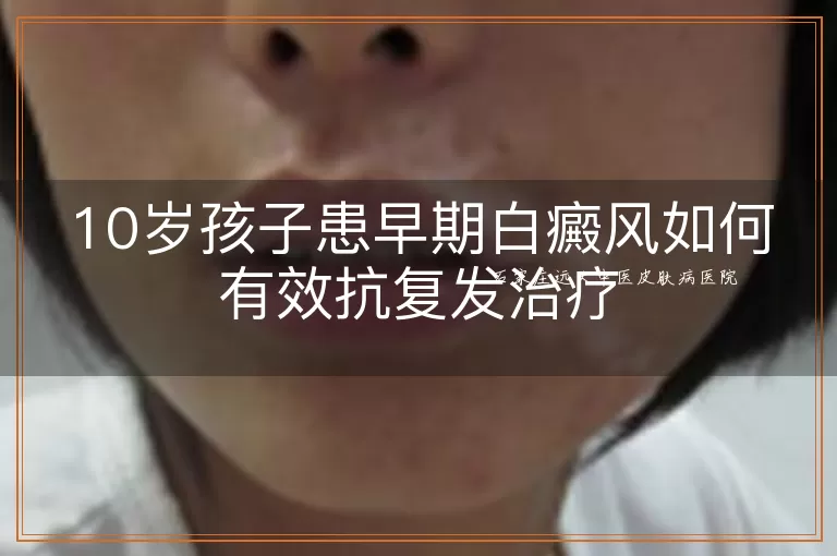 10岁孩子患早期白癜风如何有效抗复发治疗