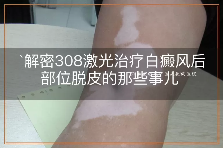 解密308激光治疗白癜风后部位脱皮的那些事儿