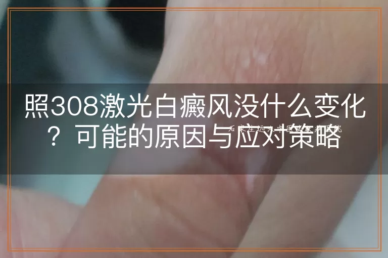 照308激光白癜风没什么变化？可能的原因与应对策略