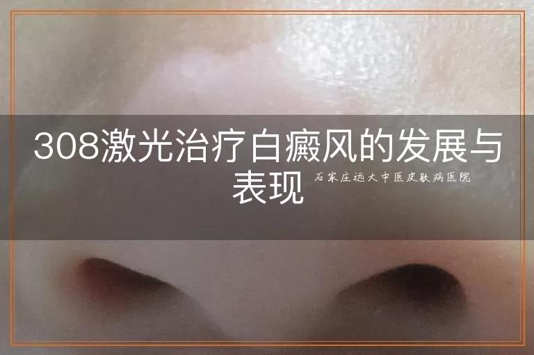 308激光治疗白癜风的发展与表现