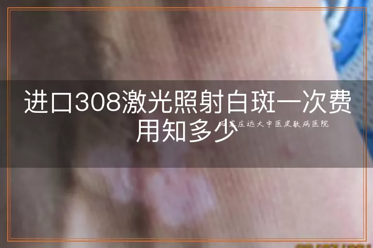进口308激光照射白斑一次费用知多少