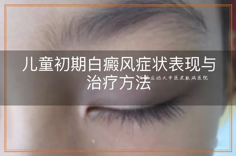 儿童初期白癜风症状表现与治疗方法