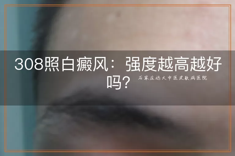 308照白癜风：强度越高越好吗？