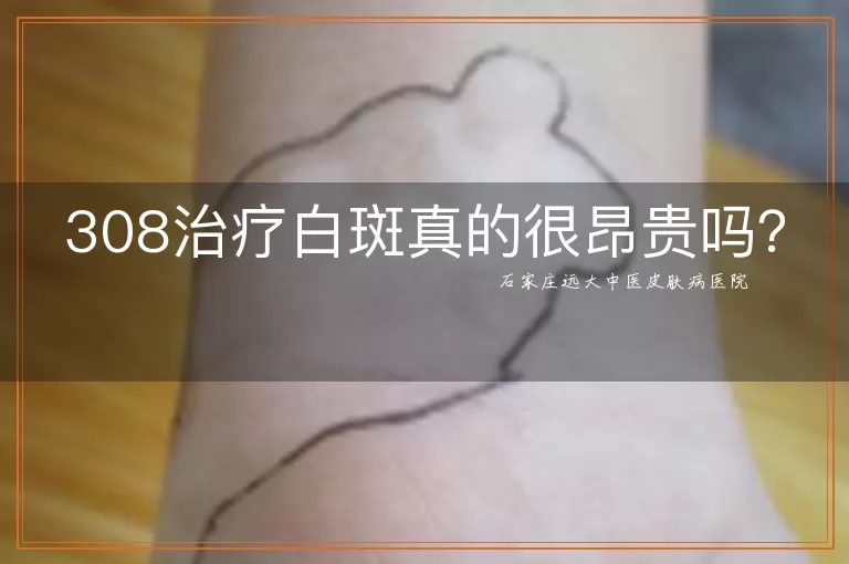 308治疗白斑真的很昂贵吗？