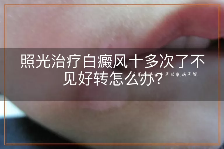 照光治疗白癜风十多次了不见好转怎么办？