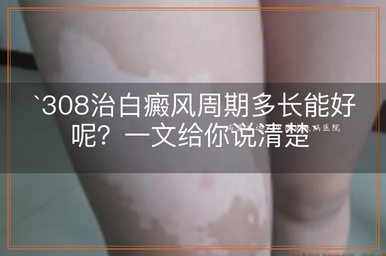 308治白癜风周期多长能好呢？一文给你说清楚