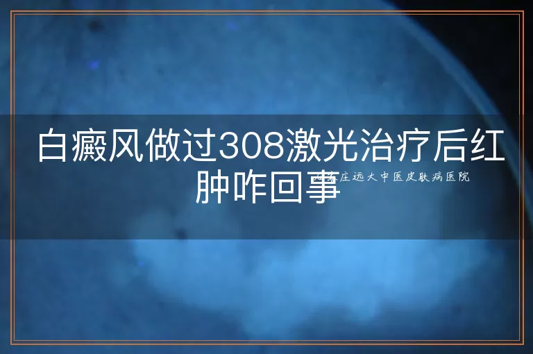白癜风做过308激光治疗后红肿咋回事