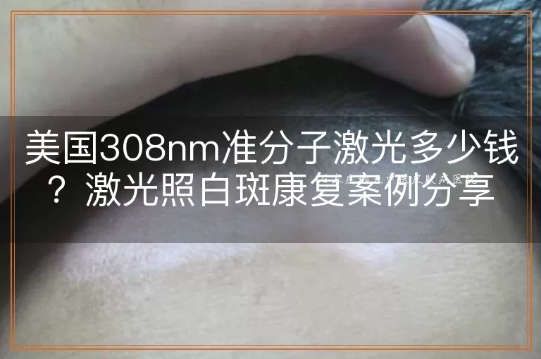 美国308nm准分子激光多少钱？激光照白斑康复案例分享