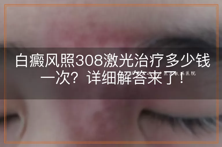 白癜风照308激光治疗多少钱一次？详细解答来了！