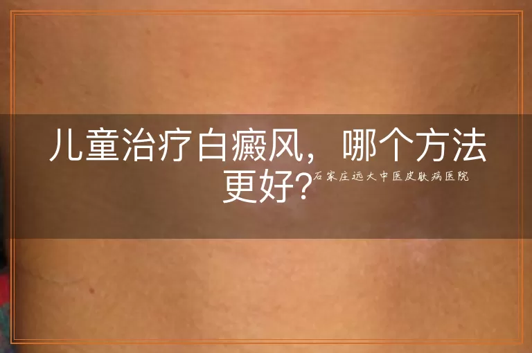 儿童治疗白癜风，哪个方法更好？