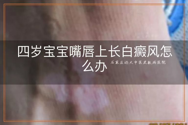 四岁宝宝嘴唇上长白癜风怎么办