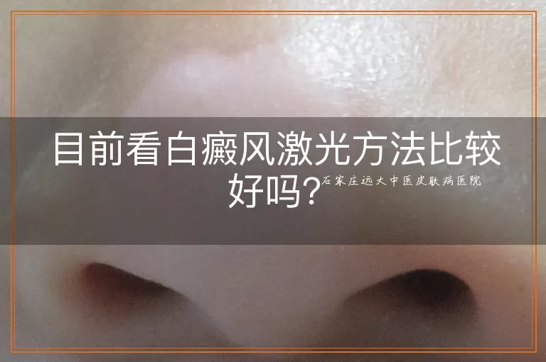 目前看白癜风激光方法比较好吗？