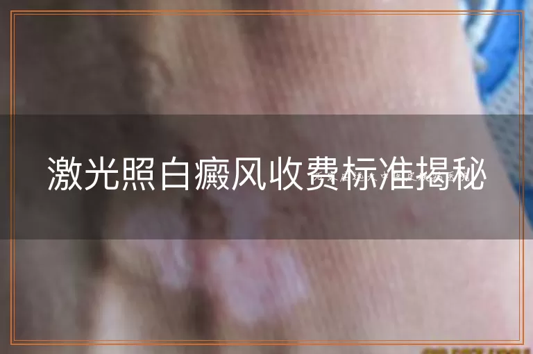 激光照白癜风收费标准揭秘