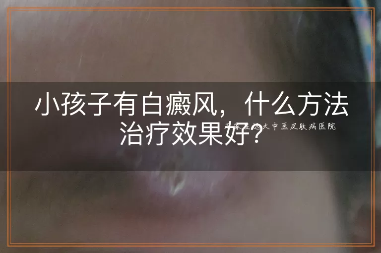 小孩子有白癜风，什么方法治疗效果好？