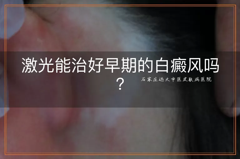 激光能治好早期的白癜风吗？