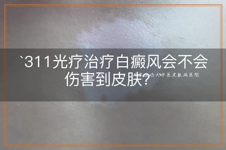 311光疗治疗白癜风会不会伤害到皮肤？
