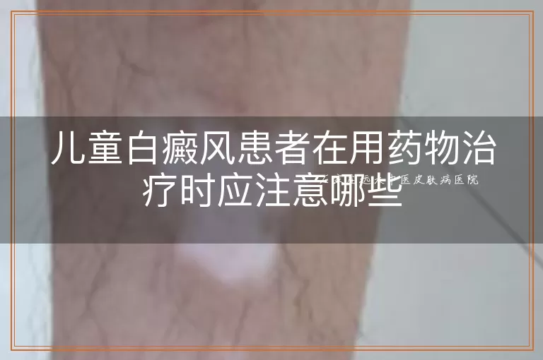 儿童白癜风患者在用药物治疗时应注意哪些