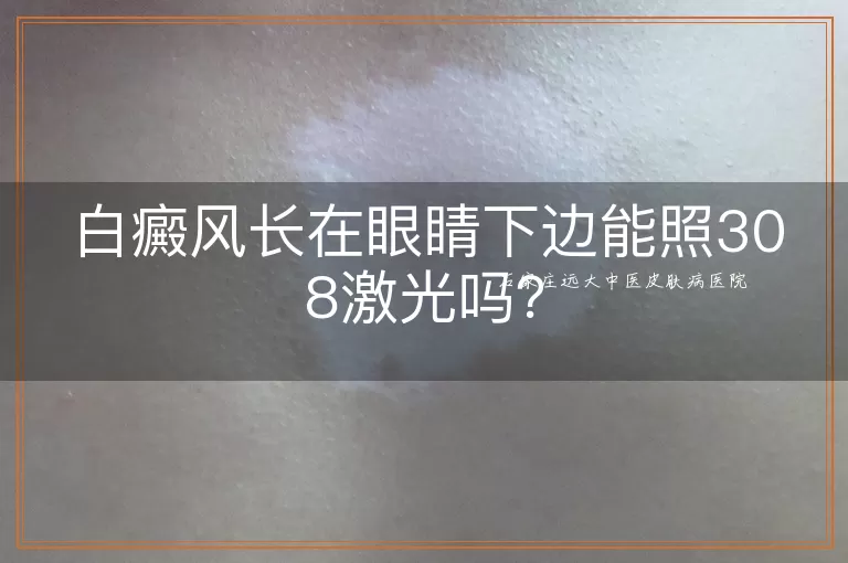 白癜风长在眼睛下边能照308激光吗?