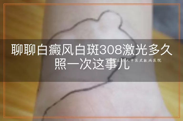聊聊白癜风白斑308激光多久照一次这事儿