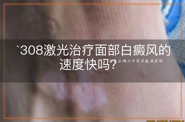 308激光治疗面部白癜风的速度快吗？