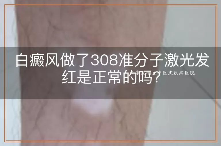 白癜风做了308准分子激光发红是正常的吗？