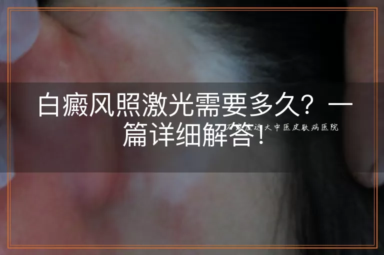 白癜风照激光需要多久？一篇详细解答！