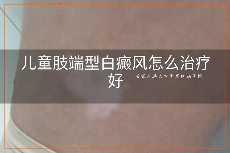 儿童肢端型白癜风怎么治疗好