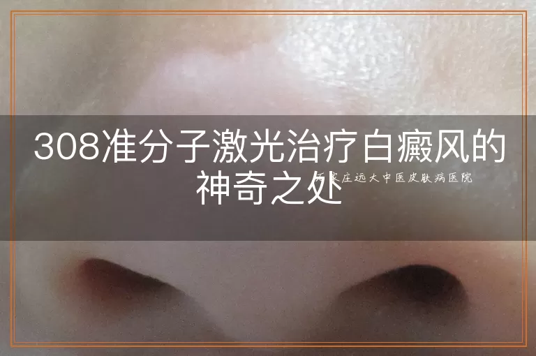 308准分子激光治疗白癜风的神奇之处