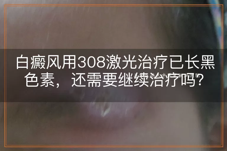 白癜风用308激光治疗已长黑色素，还需要继续治疗吗？