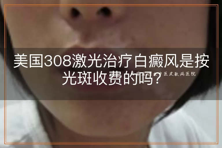 美国308激光治疗白癜风是按光斑收费的吗？