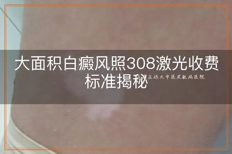 大面积白癜风照308激光收费标准揭秘