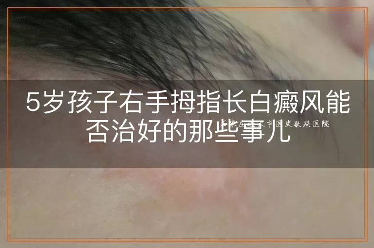 5岁孩子右手拇指长白癜风能否治好的那些事儿