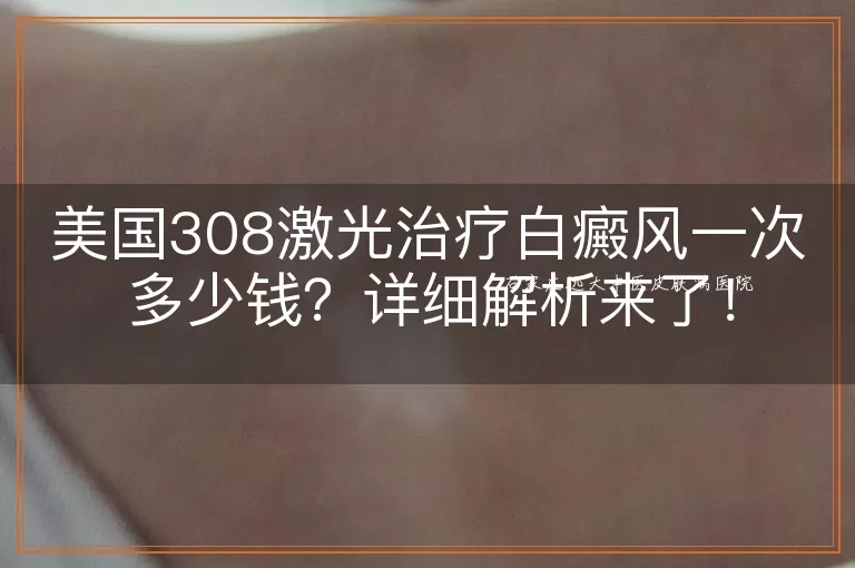 美国308激光治疗白癜风一次多少钱？详细解析来了！
