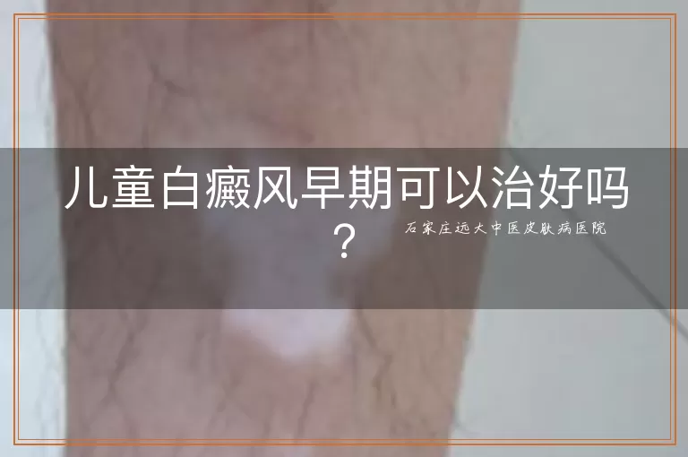 儿童白癜风早期可以治好吗？