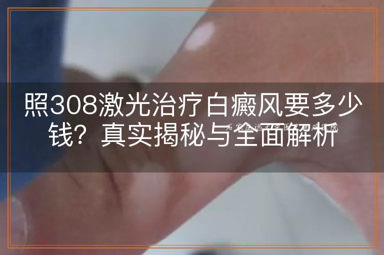 照308激光治疗白癜风要多少钱？真实揭秘与全面解析