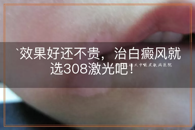 效果好还不贵，治白癜风就选308激光吧！