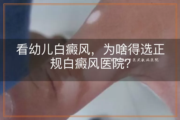 看幼儿白癜风，为啥得选正规白癜风医院？