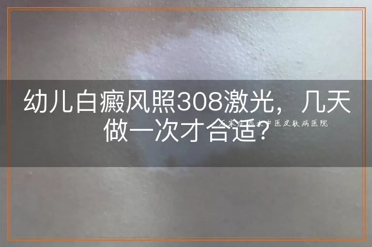 幼儿白癜风照308激光，几天做一次才合适？