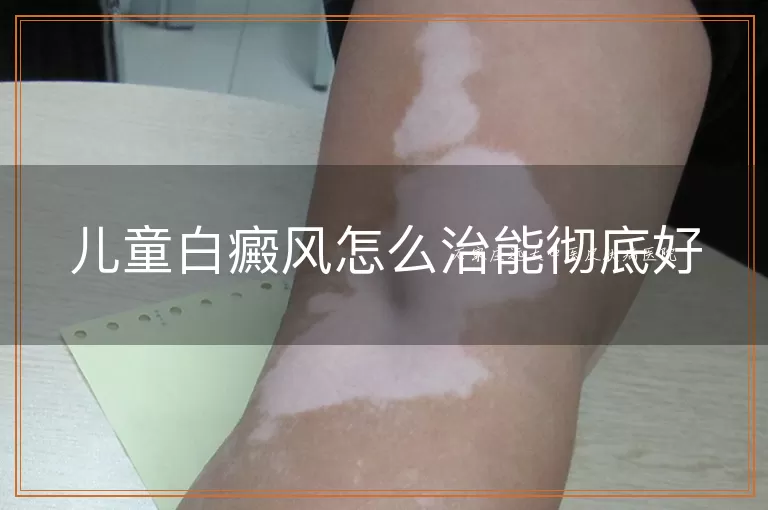 儿童白癜风怎么治能彻底好
