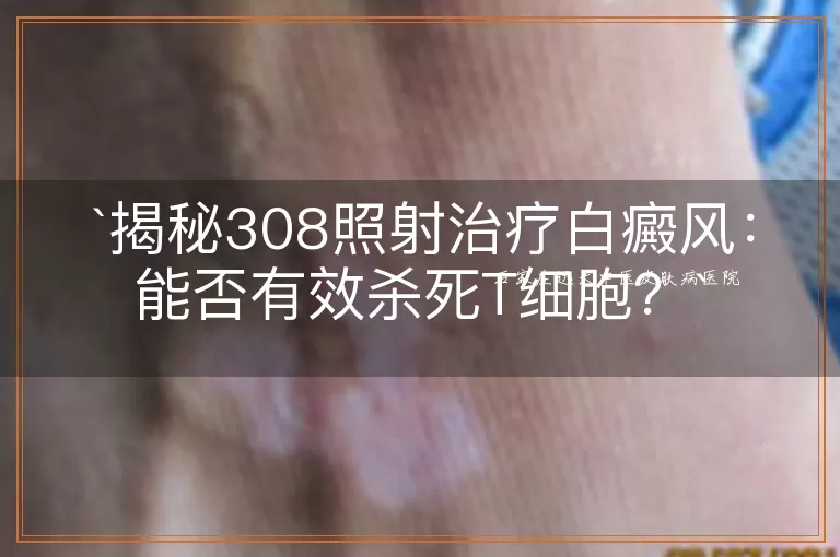揭秘308照射治疗白癜风：能否有效杀死T细胞？