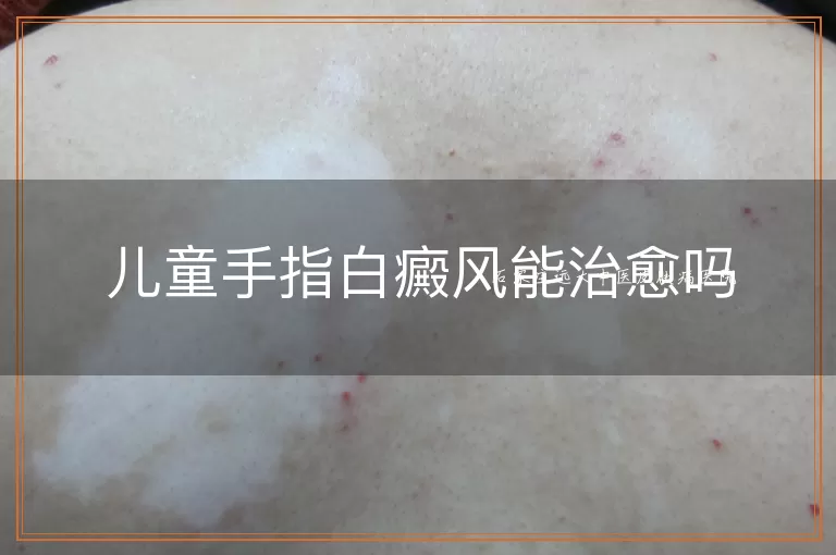 儿童手指白癜风能治愈吗