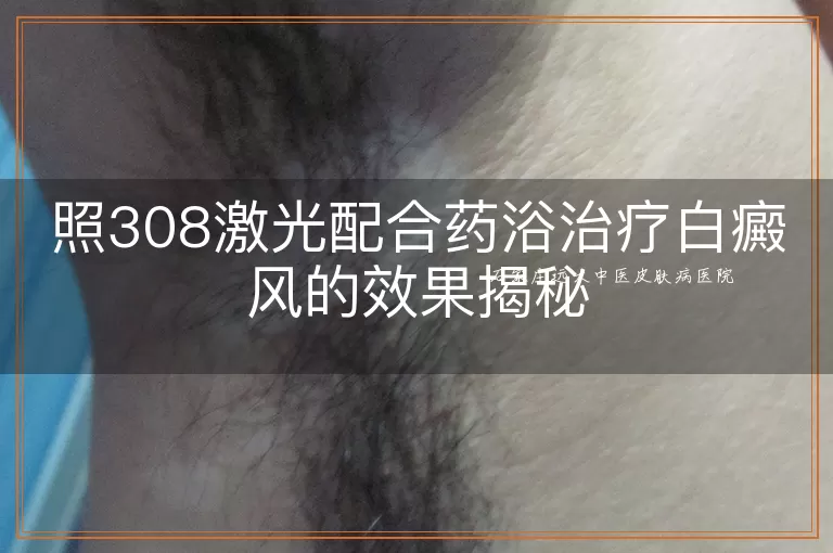 照308激光配合药浴治疗白癜风的效果揭秘