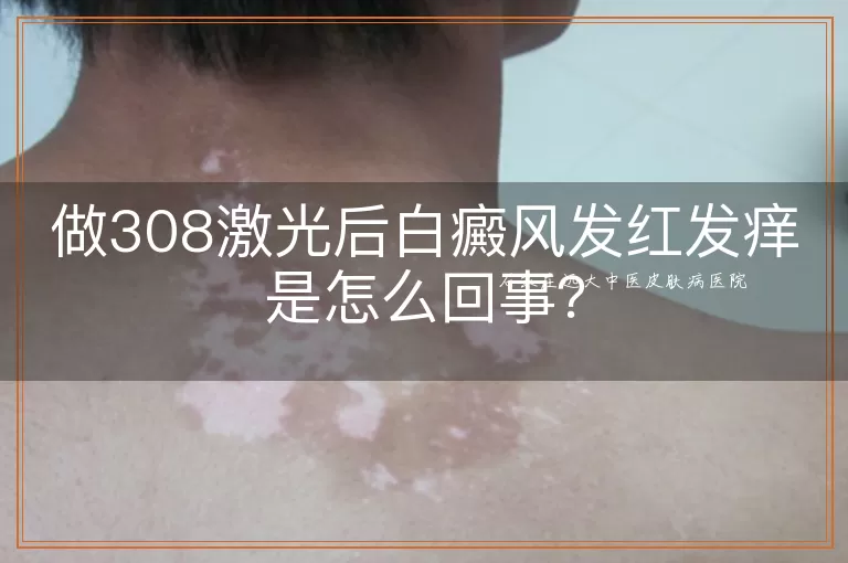 做308激光后白癜风发红发痒是怎么回事?