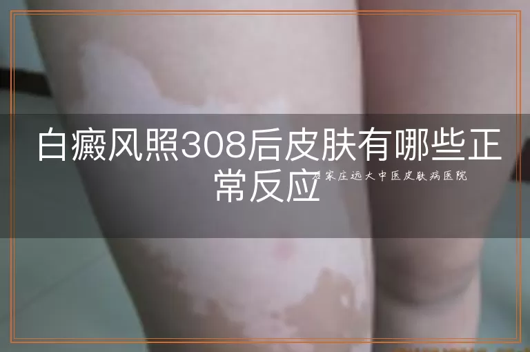白癜风照308后皮肤有哪些正常反应