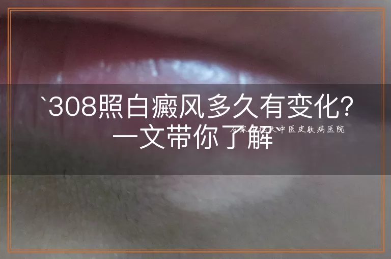 308照白癜风多久有变化?一文带你了解