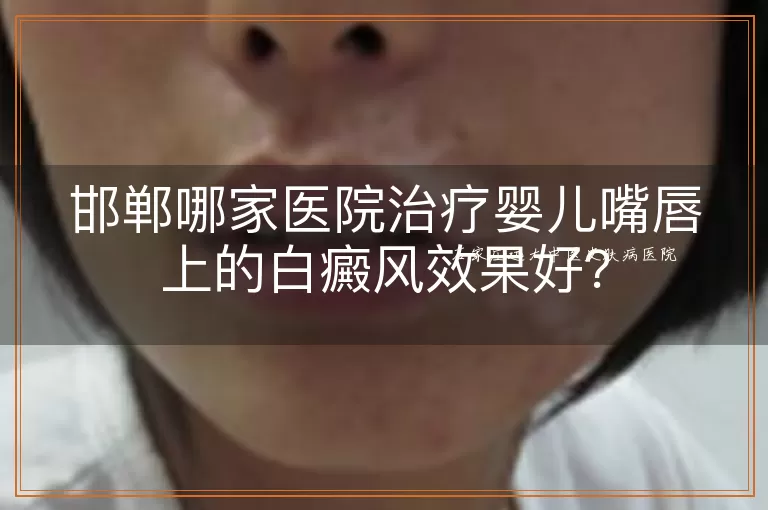 邯郸哪家医院治疗婴儿嘴唇上的白癜风效果好？