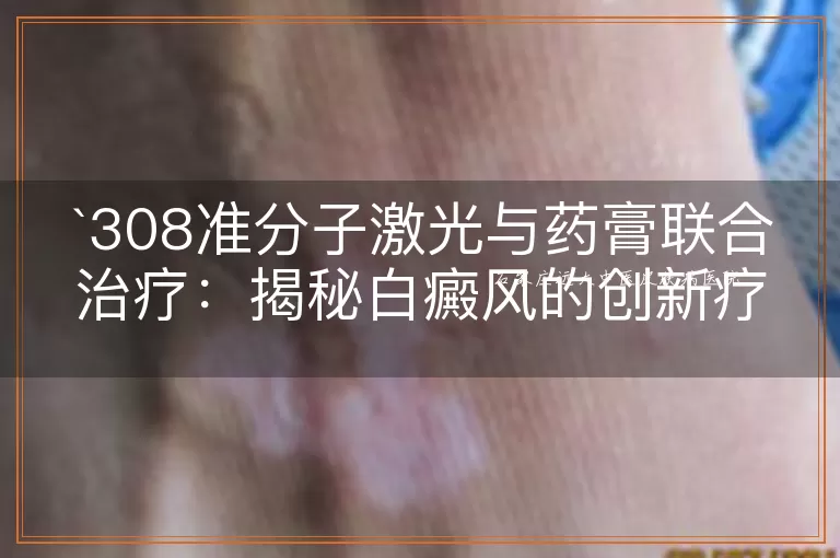 308准分子激光与药膏联合治疗：揭秘白癜风的创新疗法