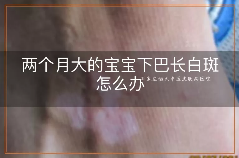 两个月大的宝宝下巴长白斑怎么办